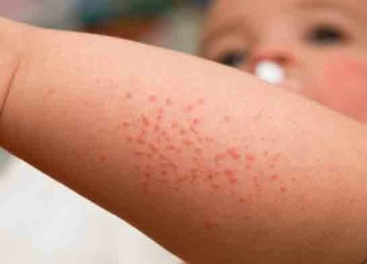 Çocuklarda Pişik Belirtileri ve Tedavisi