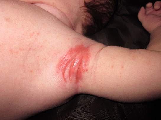 Bebek Koltuk Altı Pişik Belirtileri ve Tedavisi