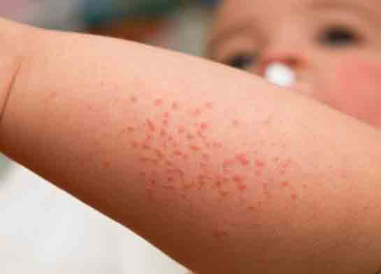 Çocuklarda Pişik Belirtileri ve Tedavisi